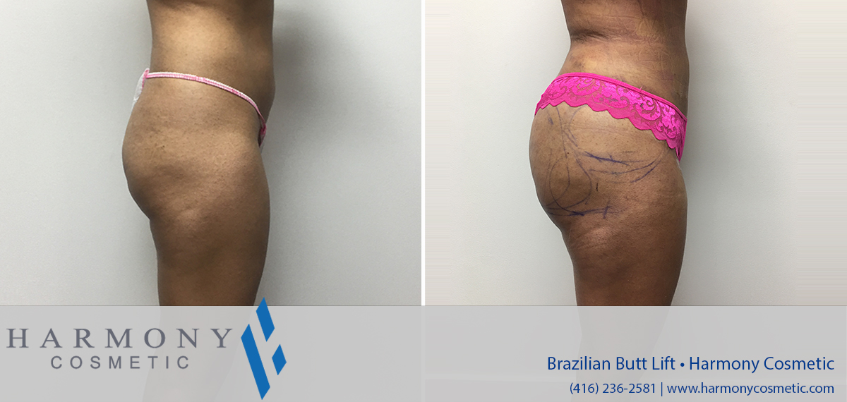 Brazilian Buttock Lift Before & After Gallery