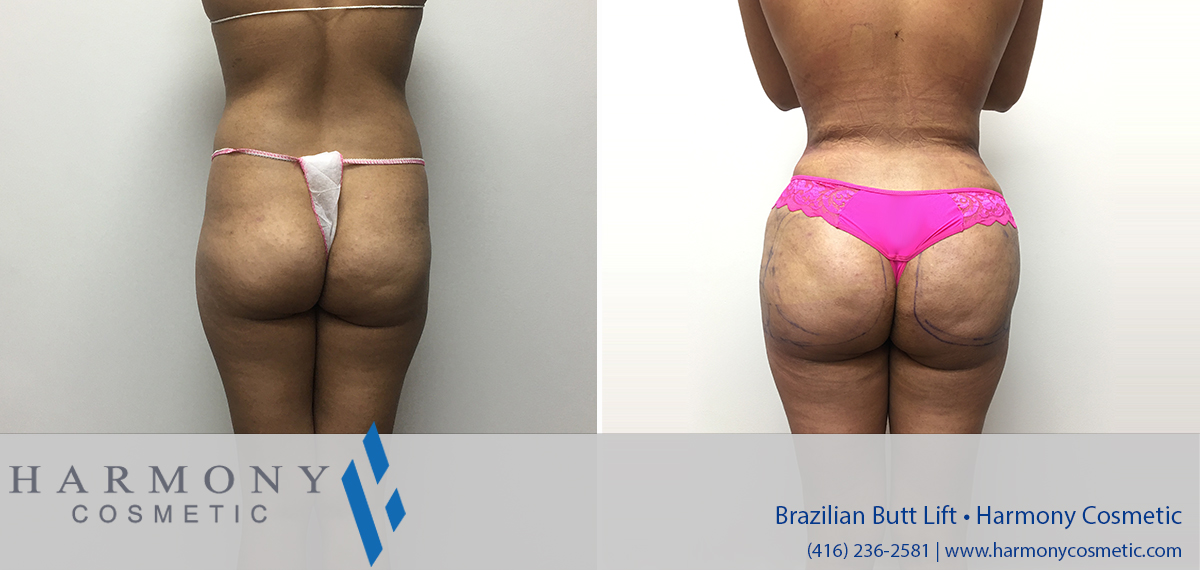 Brazilian Buttock Lift  Harmony Cosmetic Clinic