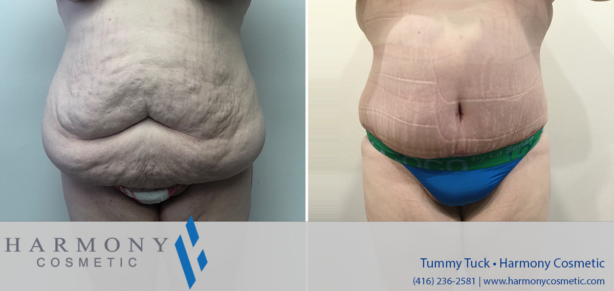 Achieve a Flatter, Firmer Abdomen with Tummy Tuck in Toronto