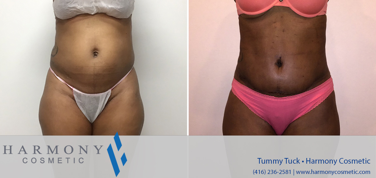 Achieve a Flatter, Firmer Abdomen with Tummy Tuck in Toronto